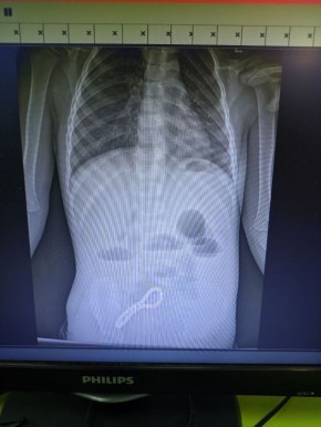 Хирурги Рязанской ОДКБ спасли малыша, проглотившего 30 шариков магнитного браслета, об этом сообщили региональном минздраве